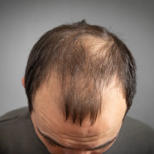 causes of hair loss in women